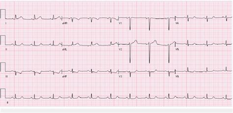 nonspecific t wave abnormality